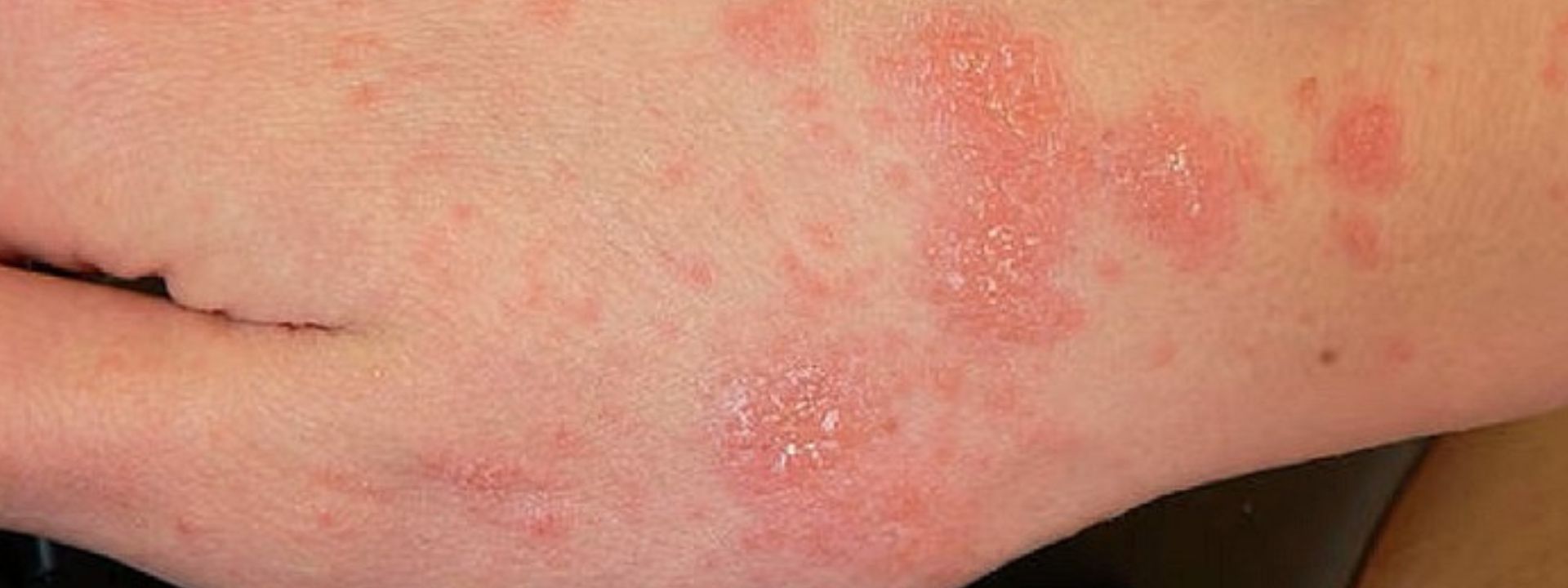  La scabbia torna a colpire pesantemente in Italia