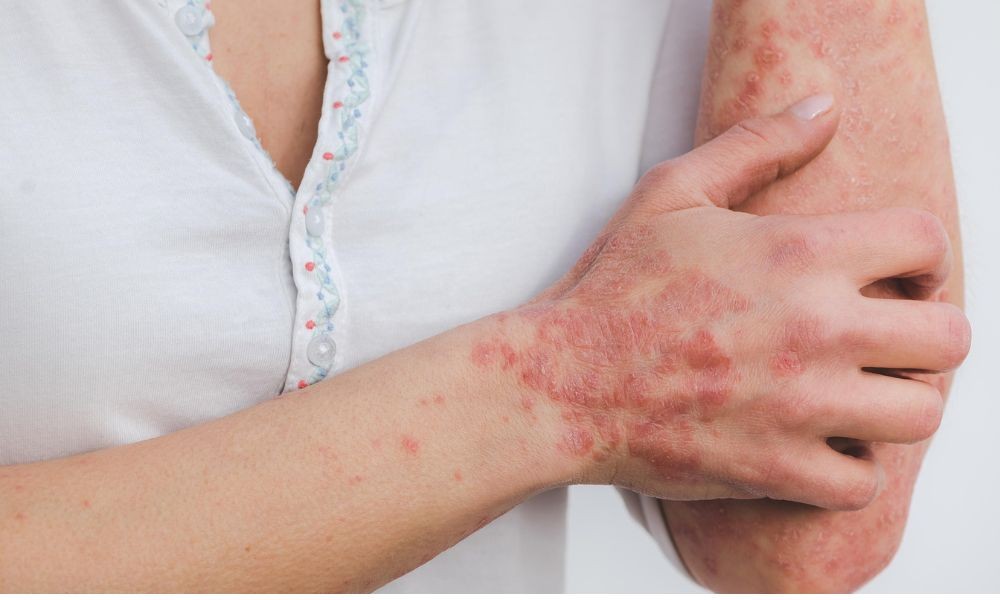 IDI, scoperto un meccanismo che amplifica l’infiammazione nella psoriasi